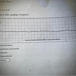 Aacn identifying dysrhythmias exam answers